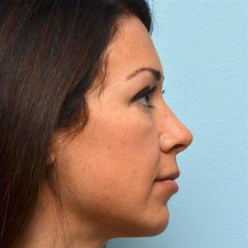 Jaw Fillers