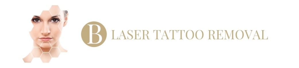 Laser Tattoo Removal